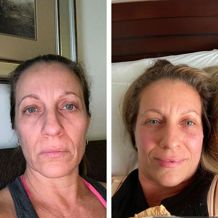 Before and after facial comparison showing patient results from breast implant removal procedure